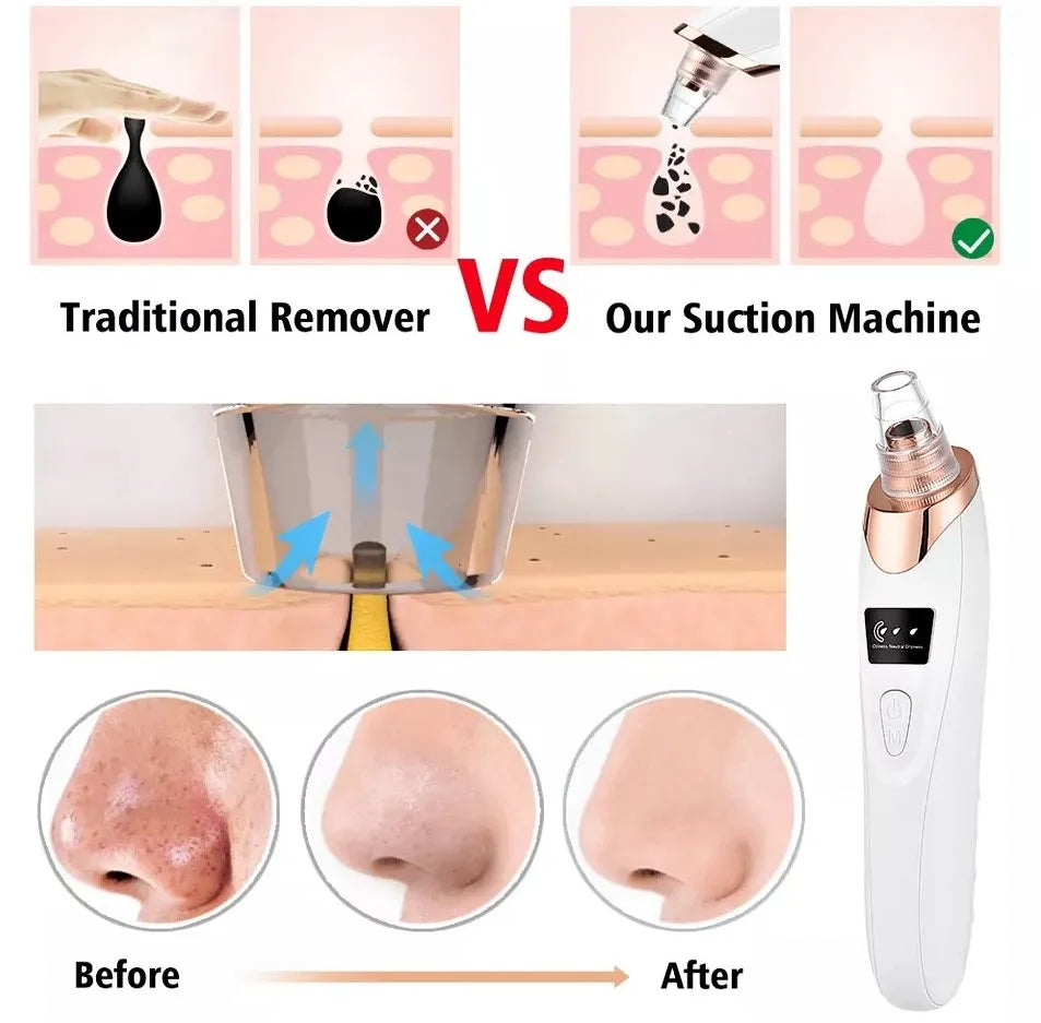 5-in-1 Rechargeable Blackhead Remover Machine – Facial Pore Vacuum with 5 Interchangeable Heads